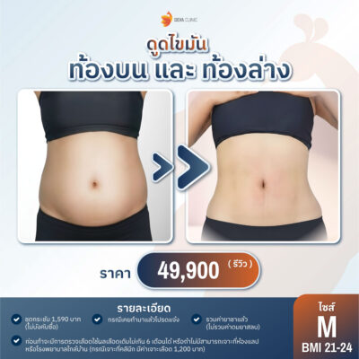 ราคาดูดไขมันหน้าท้อง ปี 2026 M