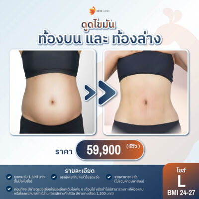 ราคาดูดไขมันหน้าท้อง ปี 2026 L