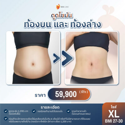 ราคาดูดไขมันหน้าท้อง ปี 2026 XL