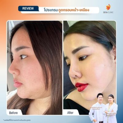 ผลลัพธ์หลังทำ ดูดหน้า เหนียง 10