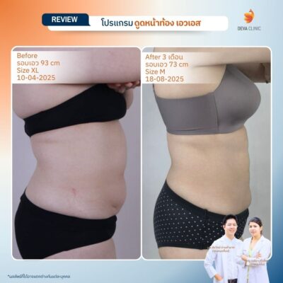 รีวิวก่อนทำ หลังทำ ดูดไขมันหน้าท้อง 8