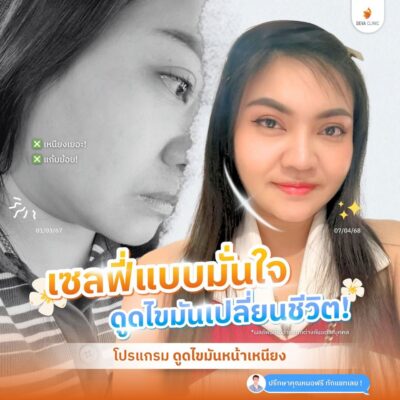 รีวิวเคสก่อน-หลัง ดูดไขมันคาง 1