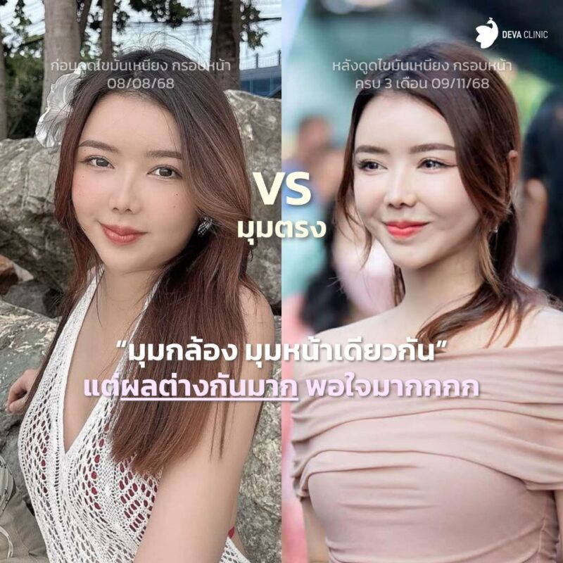 การดูดไขมันหน้า: วิธีที่แพทย์แนะนำสำหรับการกำจัดเซลล์ไขมันถาวรในปี 2026