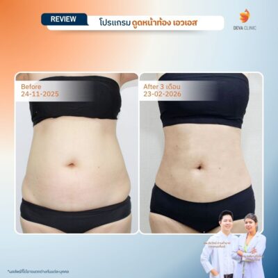 รีวิวแก้หน้าท้องย้วย หลังคลอด 11