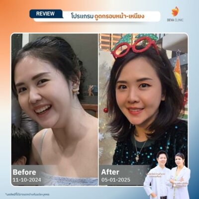 ผลลัพธ์หลังทำ ดูดหน้า เหนียง 8