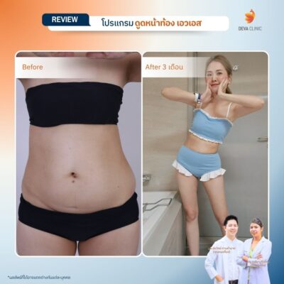 รีวิวแก้หน้าท้องย้วย หลังคลอด 6
