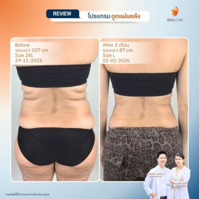 รีวิวการเปลี่ยนไซส์เสื้อผ้าหลังดูดไขมันหลังที่ Deva Clinic 2