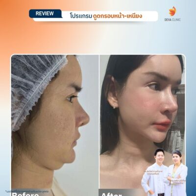 รีวิวดูดไขมันเหนียง ผลลัพธ์ก่อนหลัง 10
