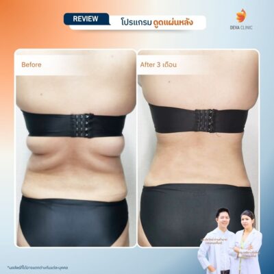 รีวิวการเปลี่ยนไซส์เสื้อผ้าหลังดูดไขมันหลังที่ Deva Clinic 3