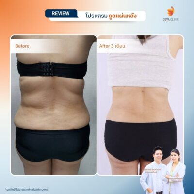 รีวิวการเปลี่ยนไซส์เสื้อผ้าหลังดูดไขมันหลังที่ Deva Clinic 4