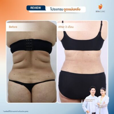 รีวิวการเปลี่ยนไซส์เสื้อผ้าหลังดูดไขมันหลังที่ Deva Clinic 5