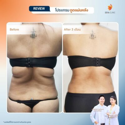 รีวิวการเปลี่ยนไซส์เสื้อผ้าหลังดูดไขมันหลังที่ Deva Clinic 6