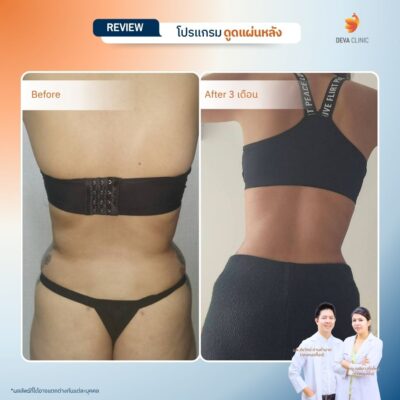รีวิวการเปลี่ยนไซส์เสื้อผ้าหลังดูดไขมันหลังที่ Deva Clinic 7