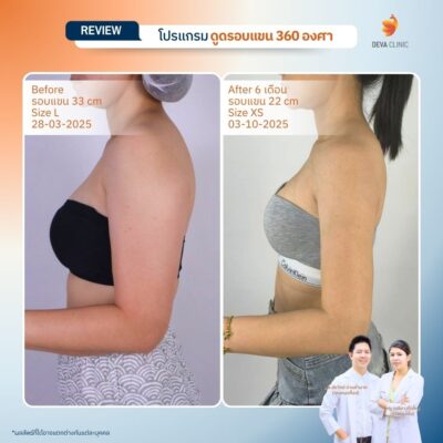 รีวิวดูดไขมันคนผอม ต้นแขน 9