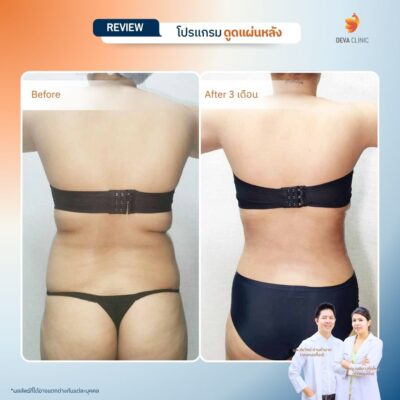 รีวิวการเปลี่ยนไซส์เสื้อผ้าหลังดูดไขมันหลังที่ Deva Clinic 8