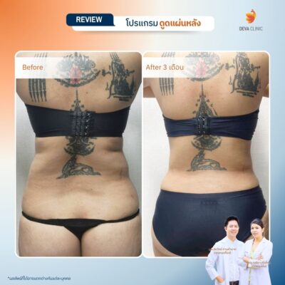 รีวิวการเปลี่ยนไซส์เสื้อผ้าหลังดูดไขมันหลังที่ Deva Clinic 9