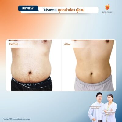 รีวิวก่อนหลัง ดูดไขมันหน้าท้องผู้ชาย 2