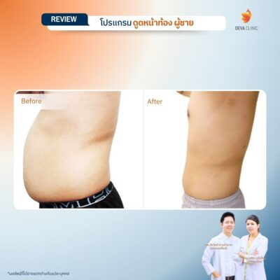 รีวิวก่อนหลัง ดูดไขมันหน้าท้องผู้ชาย 5