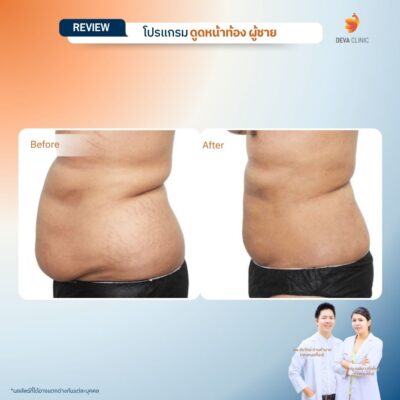 รีวิวก่อนหลัง ดูดไขมันหน้าท้องผู้ชาย 4