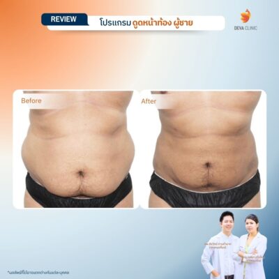 รีวิวก่อนหลัง ดูดไขมันหน้าท้องผู้ชาย 1
