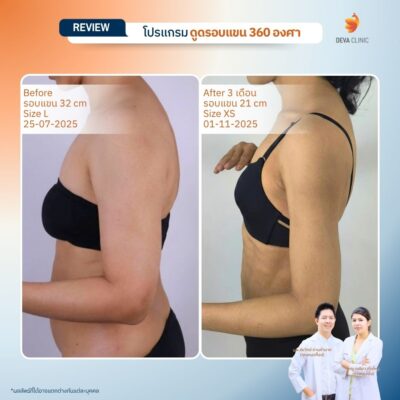 รีวิวดูดไขมันคนผอม ต้นแขน 23