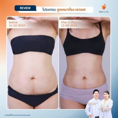 รีวิวดูดไขมันคนผอม หน้าท้อง 3