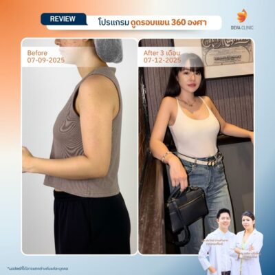 รีวิวดูดไขมันคนผอม ต้นแขน 21