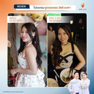 รีวิวดูดไขมันคนผอม ต้นแขน 19