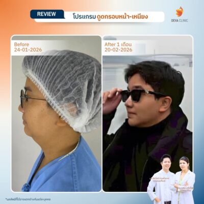รีวิวเคสก่อน-หลัง ดูดไขมันคาง 9