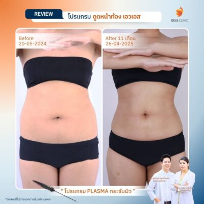 รีวิวก่อนหลังปั้นหุ่น S Curve 10