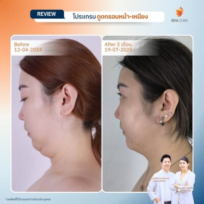 ผลลัพธ์หลังทำ ลดคางสองชั้นจากเคสจริง 16