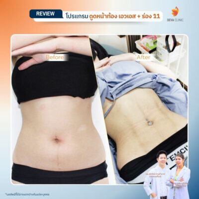 รีวิวดูดไขมัน Sexy Line 13