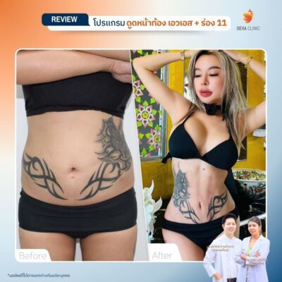 รีวิวดูดไขมัน Sexy Line 10