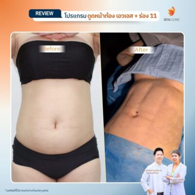 รีวิวดูดไขมัน Sexy Line 17