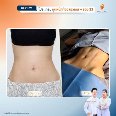 รีวิวดูดไขมัน Sexy Line 3