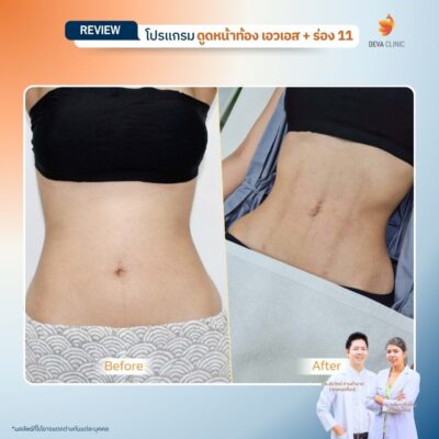รีวิวดูดไขมัน Sexy Line 11