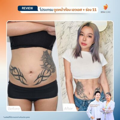 รีวิวแก้หน้าท้องย้วย หลังคลอด 4