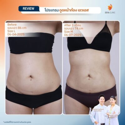 รีวิวดูดไขมันคนผอม หน้าท้อง 17