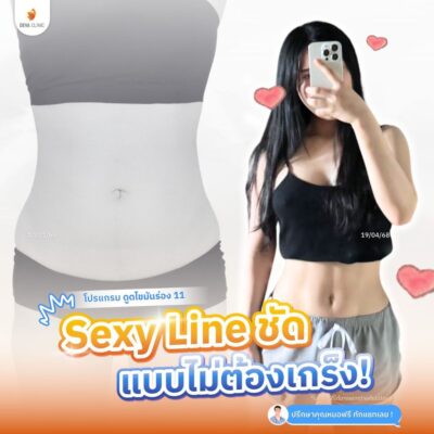 รีวิวดูดไขมัน Sexy Line คุณ