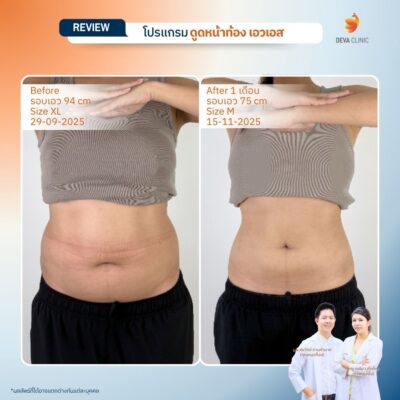 รีวิวก่อนทำ หลังทำ ดูดไขมันหน้าท้อง 14
