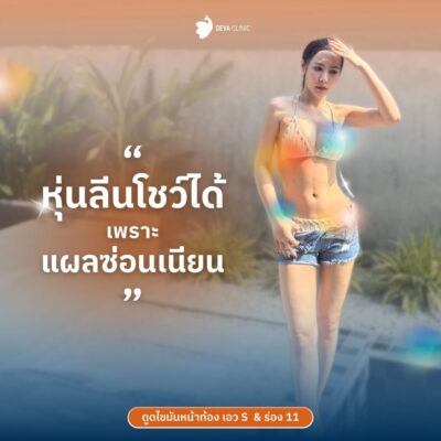 รีวิว “เทคนิคซ่อนแผลเนียน” ดูดไขมันหน้าท้อง แผลอยู่ตรงไหน 4
