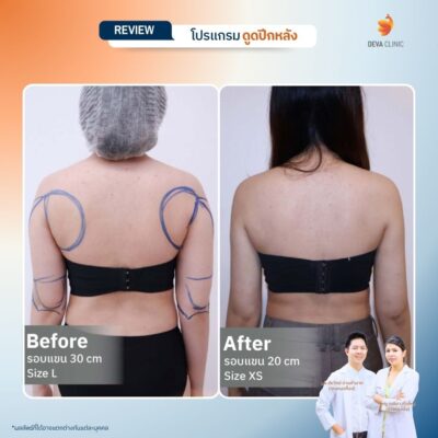 รีวิวการเปลี่ยนไซส์เสื้อผ้าหลังดูดไขมันหลังที่ Deva Clinic 10