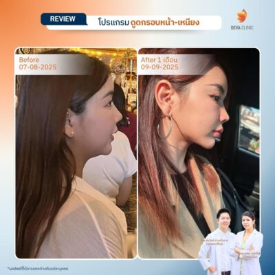 ผลลัพธ์หลังทำ ลดคางสองชั้นจากเคสจริง 1