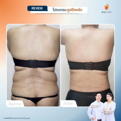 รีวิวการเปลี่ยนไซส์เสื้อผ้าหลังดูดไขมันหลังที่ Deva Clinic 1