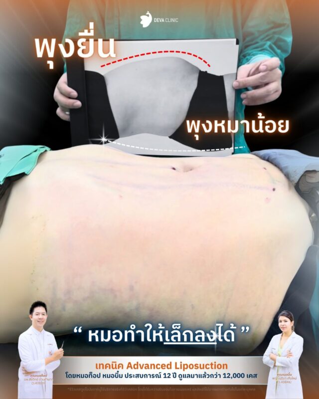 ปัญหาพุงหมาน้อยหลังคลอด: ไขมันดื้อด้าน