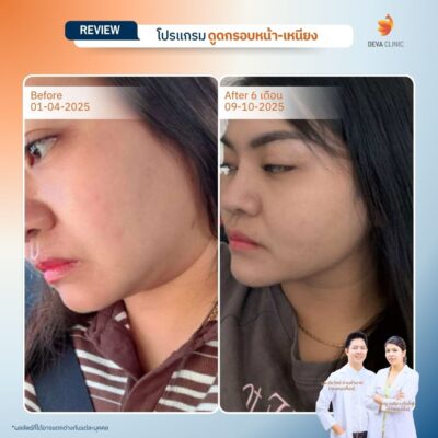 รีวิวเคสก่อน-หลัง ดูดไขมันคาง 6
