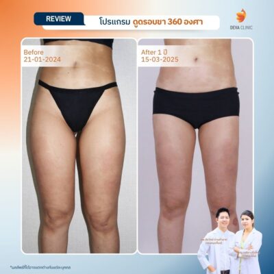 รีวิวดูดไขมันคนผอม ต้นขา 15