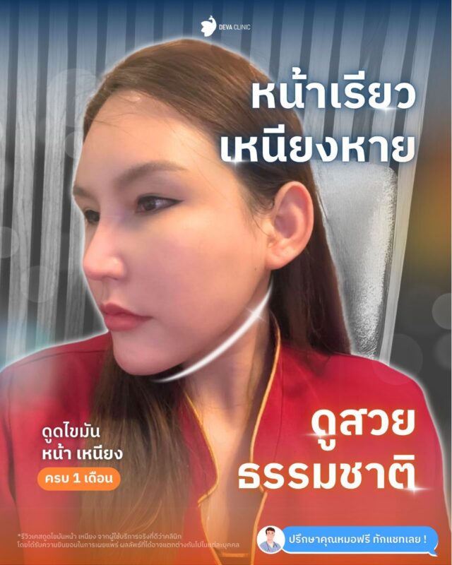 เทคนิคการดูดไขมันที่ Deva Clinic เพื่อดึงกรอบหน้าให้คมชัด