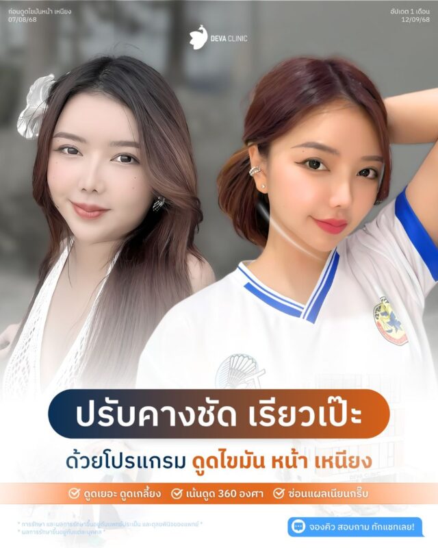 การดีไซน์กรอบหน้า: ดูดไขมันตรงไหนให้หน้าดูเล็กลงแต่ยังดูอ่อนเยาว์