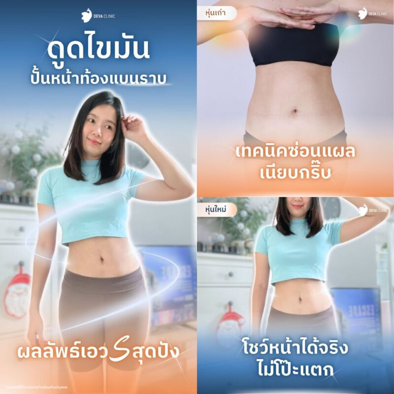 การดูดไขมันเอวเอส : มากกว่าการลดน้ำหนัก คือการสร้างสัดส่วนใหม่